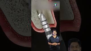 பல் பதியம் எப்படி செய்வார்கள்? -How a Dental Implant Procedure is Done? |Dr.Karthikeyan |Denta Kings