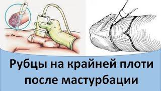 Рубцы на крайней плоти после мастурбации