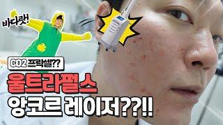 여드름흉터원정대 13탄. 여드름흉터 치료하면 바로 이것!! CO2 프락셀의 끝판왕 울트라펄스 앙코르