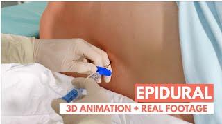 Epidural Anesthesia | 3D Animation + Real Footage