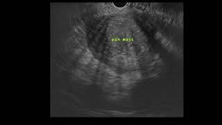 EUS-Guided Fine Needle Biopsy of a Pancreatic Mass
