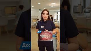 Результат в конце #еврокаппа #eurokappa #элайнеры #зубы #ортодонт #улыбка