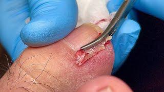 SATISYING INGROWN TOENAIL REMOVAL 