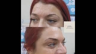 Anti-wrinkle treatment