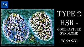 Type II Hypersensitivity in Goodpasture Syndrome #Shorts