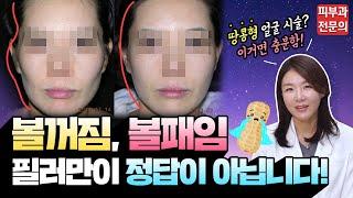 ️ 볼패임 · 볼꺼짐으로 인한 "땅콩형 얼굴" 필러, 지방이식만이 정답이 아닙니다!