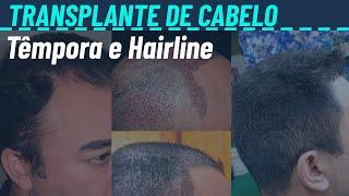 Região da têmpora e hairline no transplante capilar