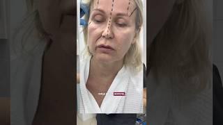  Полгода после омоложения! Пластический хирург НИКОЛАЕВА САНДАРА АФАНАСЬЕВНА