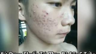 BỐC PHỐT SẢN PHẨM BÀ LÃO - Nhân chứng sống đã sử dụng thuốc trị mụn Bà Lão