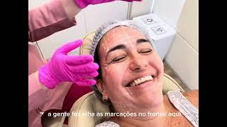 Marcações de Botox por Dra Maria Fernanda Menezes