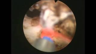 Thulium laser enucleation of the prostate, Dr. Farid Gadimaliyev