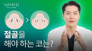 코 절골 - 내 코는 절골이 필요할까?