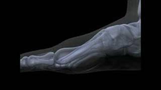 Hallux Limitus / Rigidus Surgery Functional Hallux Limitus Arthritis