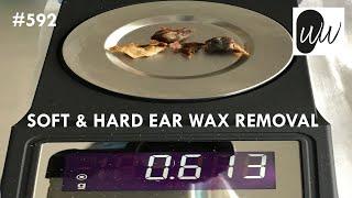 592 - Soft & Hard Ear Wax Removal