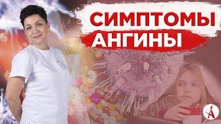 Симптомы ангины