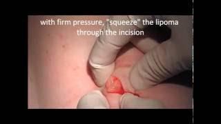 Lipoma Removal In Vivo