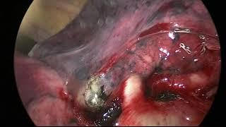 VATS Left Upper Lobe Lobectomy