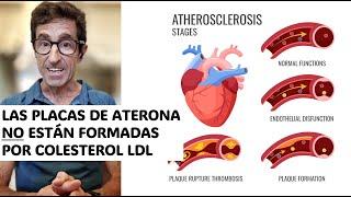 Las PLACAS de aterosclerosis NO están formadas por COLESTEROL- LDL