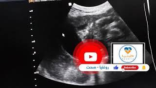 Dilated CBD with CBD Stone   Distended Gall Bladder   Distended Gallbladder With a Stone   Double Ut