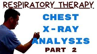 Respiratory Therapist - Chest Radiograph Interpretation Part 2 - Guess the CXR!