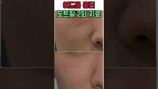 여드름흉터 도트필 2회 치료 뛰어난치료효과 닥터지니 시술