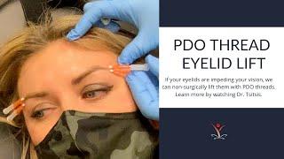 Non-Surgical Eyelid Lift with PDO Threads