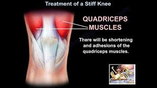 Treatment Of A Stiff Knee - Everything You Need To Know - Dr. Nabil Ebraheim