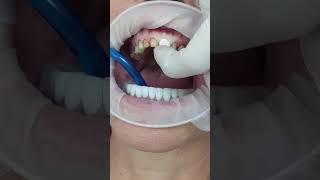 Temporary Cementation of Single Metal Ceramic Crowns #shorts