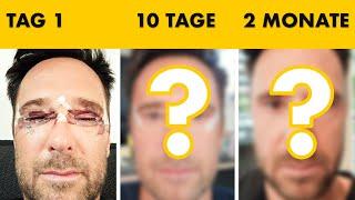 Lidstraffung - Er hat 10 Tage lang jeden Tag ein Foto gemacht | Heilungsverlauf | Dr. Jungwirth