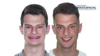 Jaw surgery Case # 105: Gustavo - Short face, overbite, maxilo-mandibular retrusion