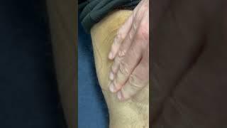 Fluid Bulging from Knee!