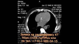 Желчекаменная болезнь на расшифровке КТ брюшной полости с контрастированием