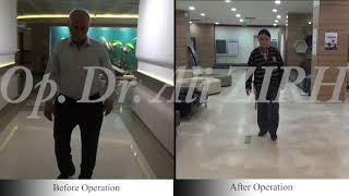 Osman YAKAN / Before and After Surgery Parkinson's Treatment DBS in Turkey