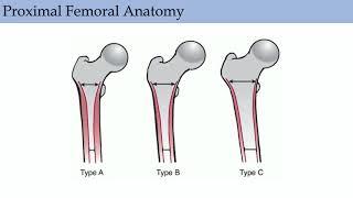 Primary Hip Replacement - ABOS Orthopedic Surgery Board Exam Review