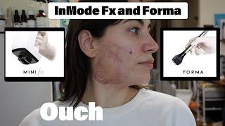 InMode FX and Forma Review: Is it Worth It?