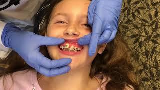 5th Braces Visit || Getting BRACES Put On 