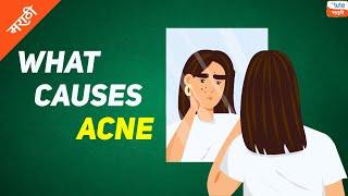 What are the causes of Acne | Acne and its causes | Letstute Marathi