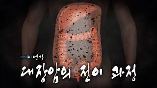 [명의 의학백과] 대장암의 전이 과정