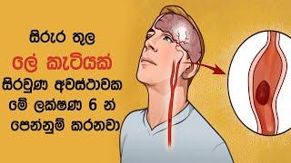 සිරුර තුල ලේ කැටියක් සිරවුණ අවස්ථාවක මේ ලක්ෂණ 6 න් පෙන්නුම් කරනවා