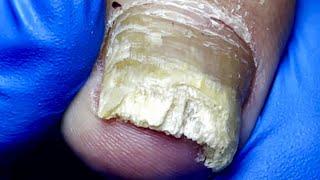 The Deteriorated Pattern On The Toenails, Cut Off All The Fungi【Pedicure Master Lin Jun】