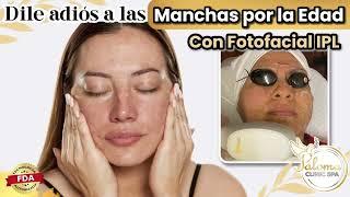 Elimina las Manchas Edad con Fotofacial laser IPL #laser #pecas #laserpecashouston #lasermanchas