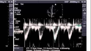 Point of Care Echo: Stroke Volume Determination