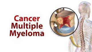 Cancer – Multiple Myeloma | Zyropathy | Care world tv