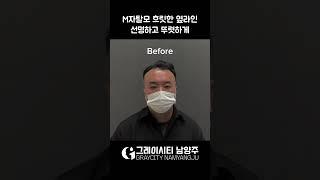 M자 탈모로 인한  넓은 이마, 흐릿한 옆라인 선명하고 뚜렷하게