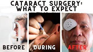 What To Expect Before, During, And After Cataract Surgery!