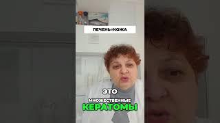 Как Печень Влияет на Вашу Кожу: Кератомы и Пятна!