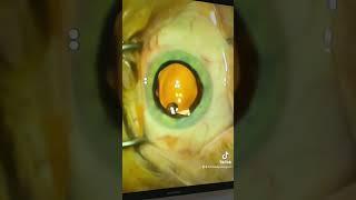 The extended range Vivity lens going in! #cataract #cataractsurgery