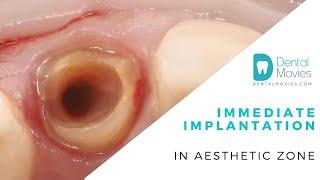 Immediate implantation in aesthetic zone
