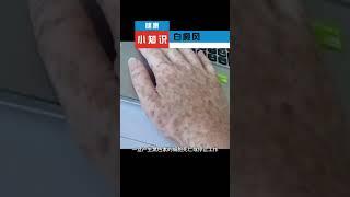 健康小知识：白癜风  #保健 #健康  #健康小貼士  #知识