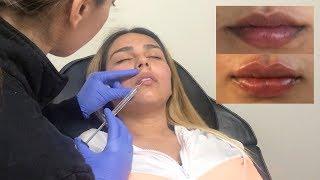 I GOT LIP FILLERS!? BEFORE AND AFTER | Brenda Huerta